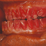 Detekcija i značaj oralnog biofilma u prevenciji i nastanku gingivo-parodontalnih oboljenja 1 desni Noć Istraživača